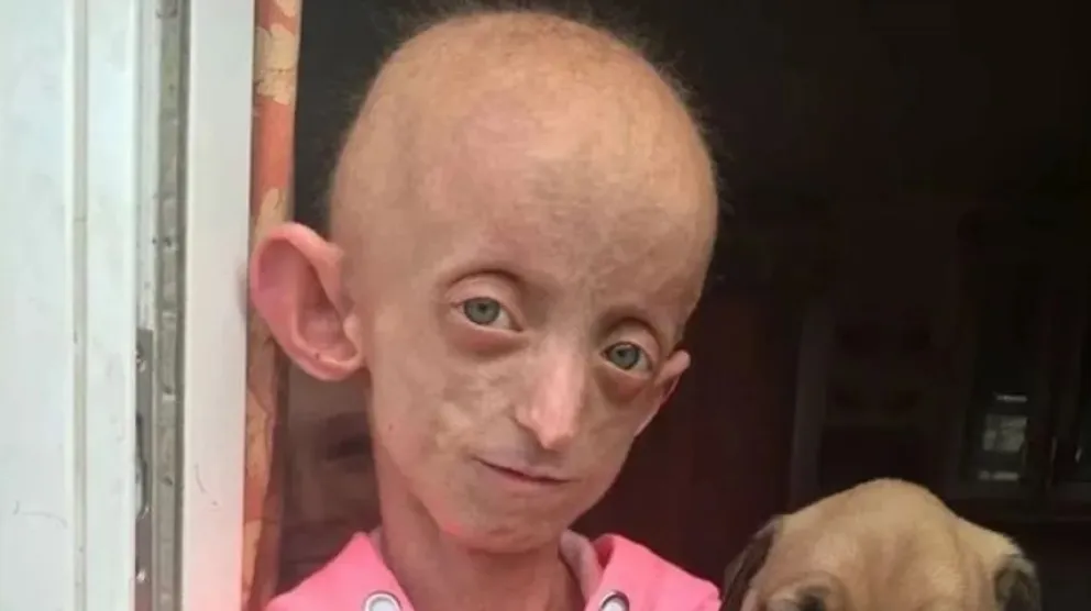 El caso de la adolescente que murió con el cuerpo de una mujer de 144 años