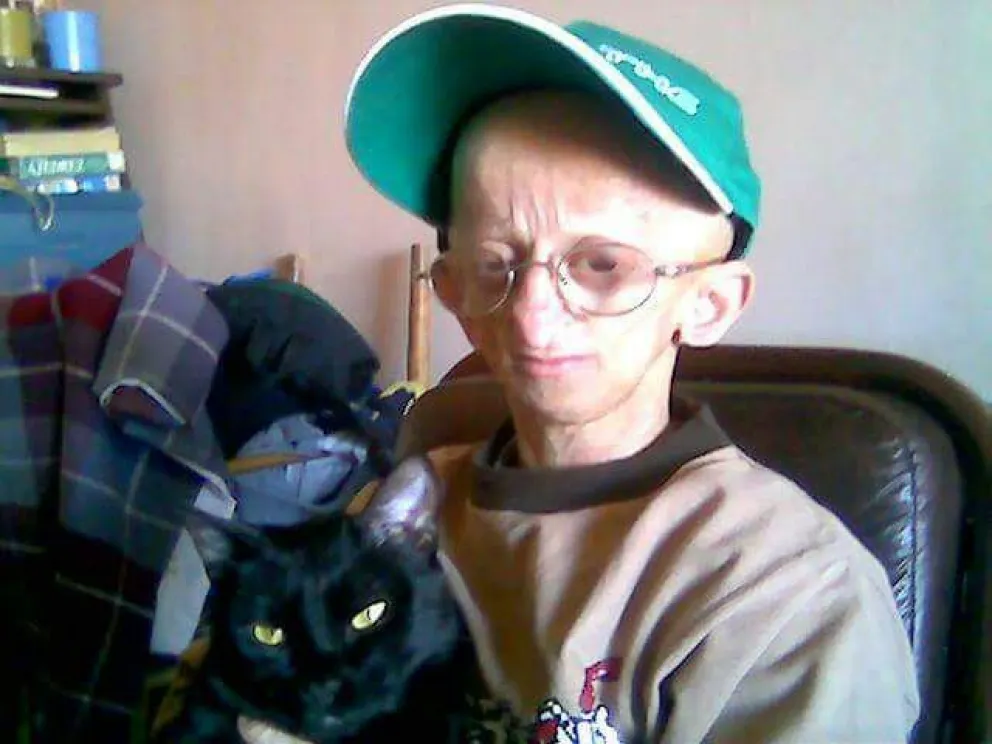 ¿Qué es la Progeria?