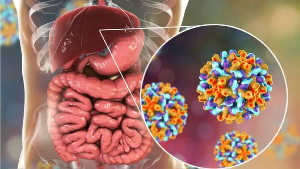 La principal causa de hepatitis es el consumo de alcohol 