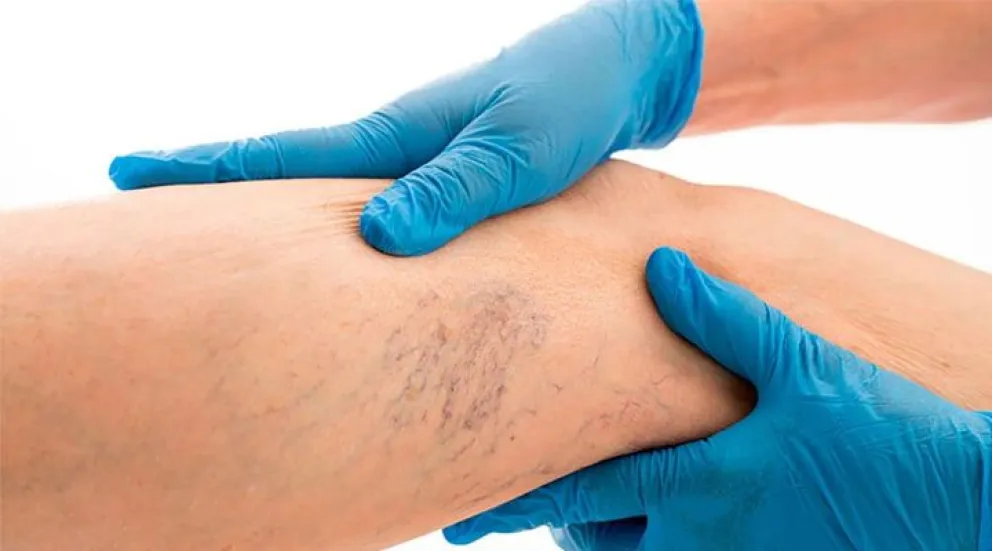 Várices en las piernas: por qué se producen y cómo hay que prevenirlas