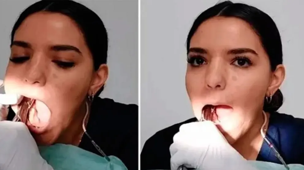 Impresionante: una dentista se sacó sus propias muelas en vivo y se hizo viral 