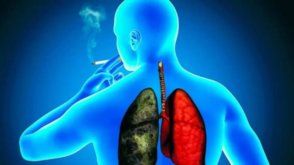 Día de la Lucha contra el Cáncer de Pulmón: cuáles son los síntomas