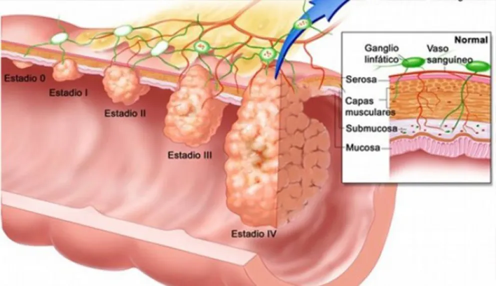 La necesaria prevención del cáncer de colon