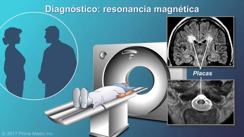 Esclerosis múltiple: la enfermedad de las mil caras