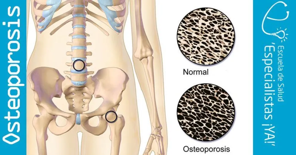 Hábitos simples para prevenir la osteoporosis