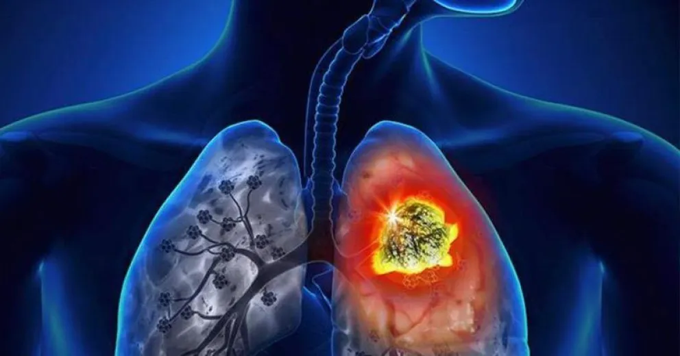 Cáncer de pulmón, principal causa de muerte por cáncer en nuestro país