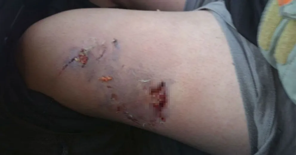 Un adolescente sufrió profundas heridas al ser atacado por un pitbull