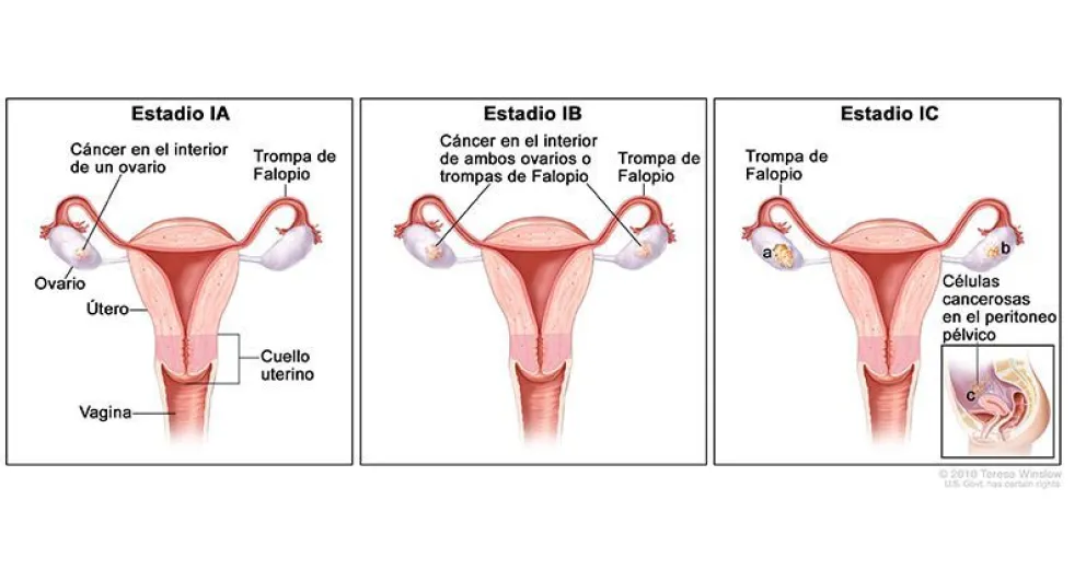 El 70% de los casos de cáncer de ovario se diagnostican en etapas avanzadas