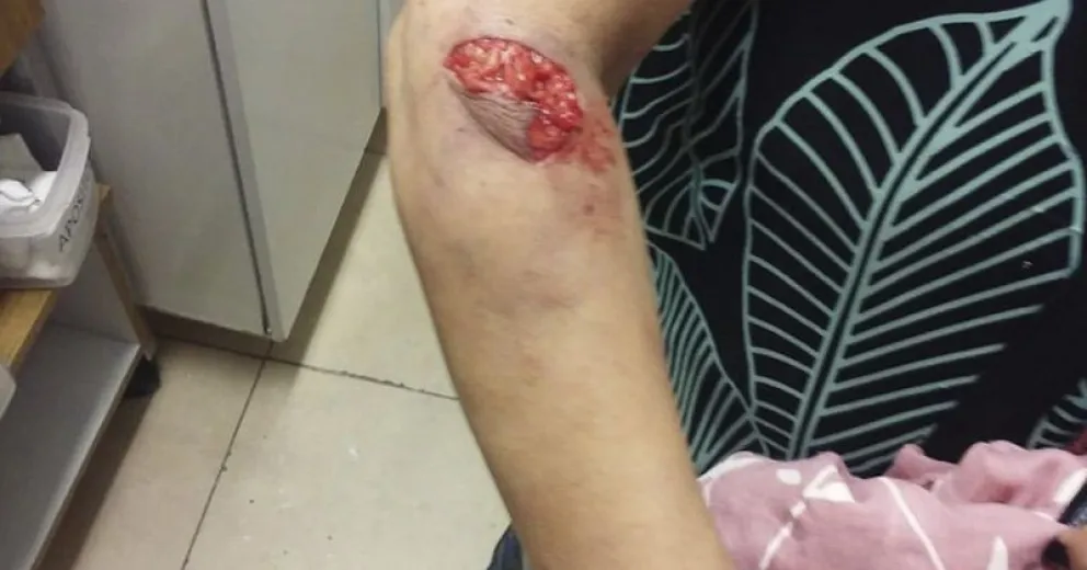 Una mujer de 70 años fue atacada por varios perros sueltos