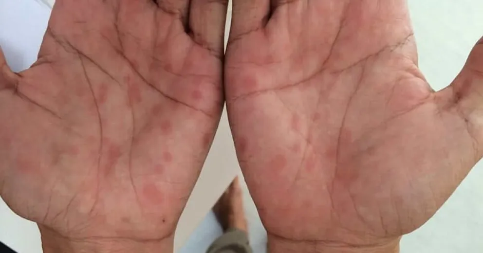 Crecen los casos de sífilis y en el hospital de Bariloche hay pocos preservativos