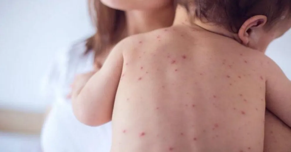 No hay casos de sarampión en Río Negro y recuerdan el calendario de vacunas