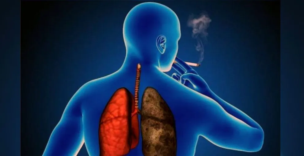 Enfermedad Pulmonar Obstructiva Crónica, claves para mejorar la calidad de vida   