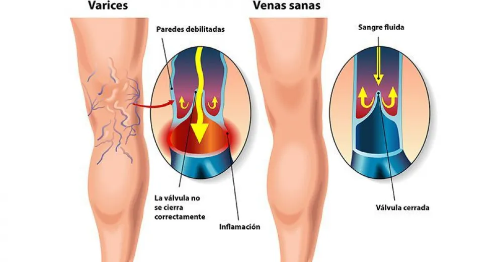 enfermedad venosa