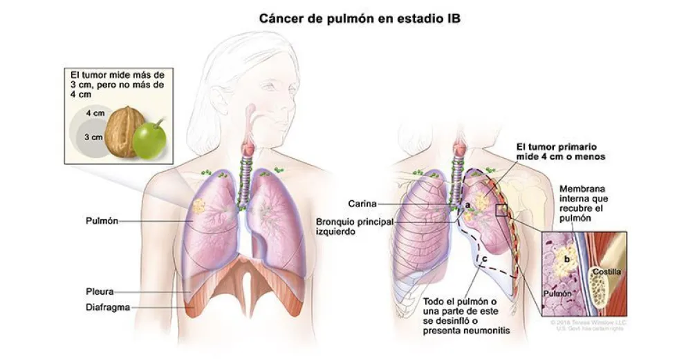 Día Mundial del Cáncer de Pulmón