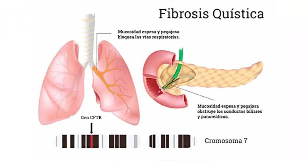 La fibrosis quística provoca daños graves en los pulmones
