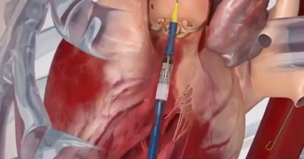 Restringen la utilización de un reemplazo de válvula cardíaca de última generación