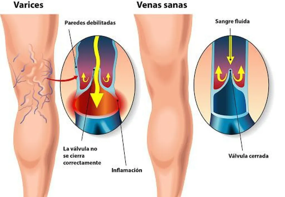 Enfermedad venosa crónica: advierten  sobre la predisposición familiar