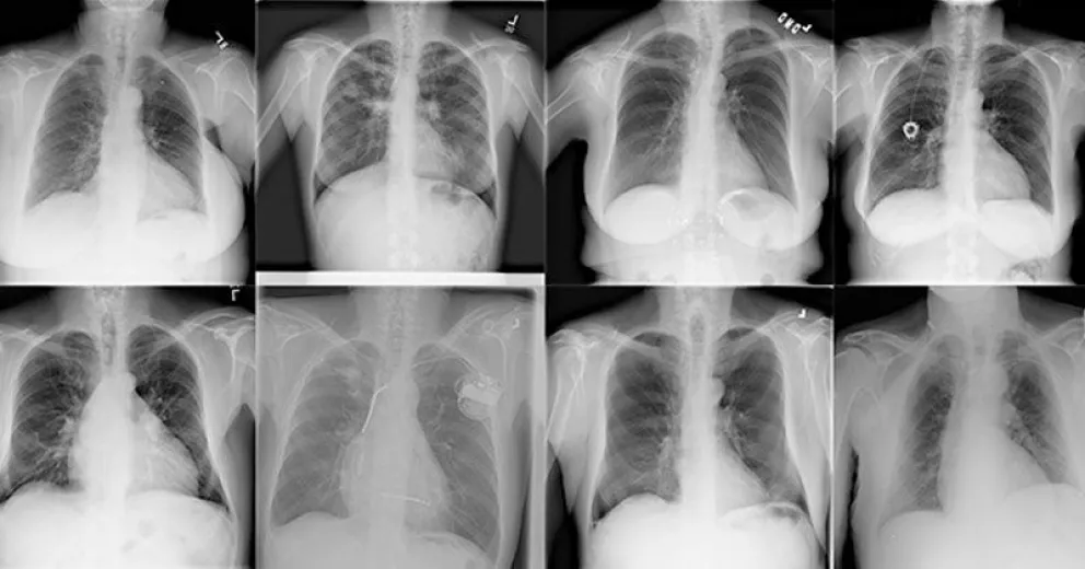 Los sistemas de inteligencia artificial pueden hacer diagnósticos con sesgo de género si no son entrenados correctamente