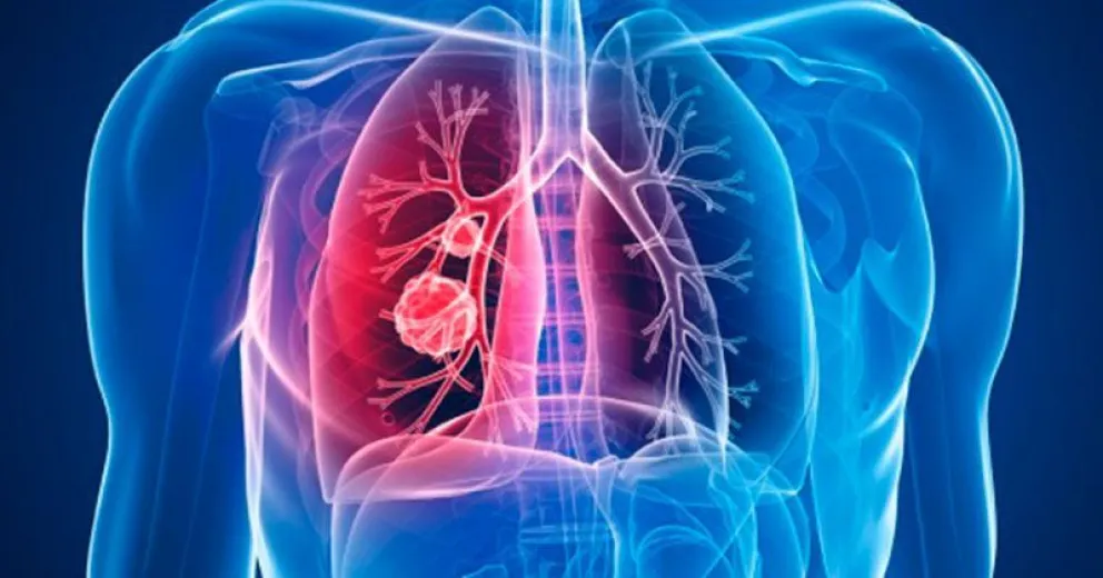 La importancia de la Ley de Fibrosis Quística