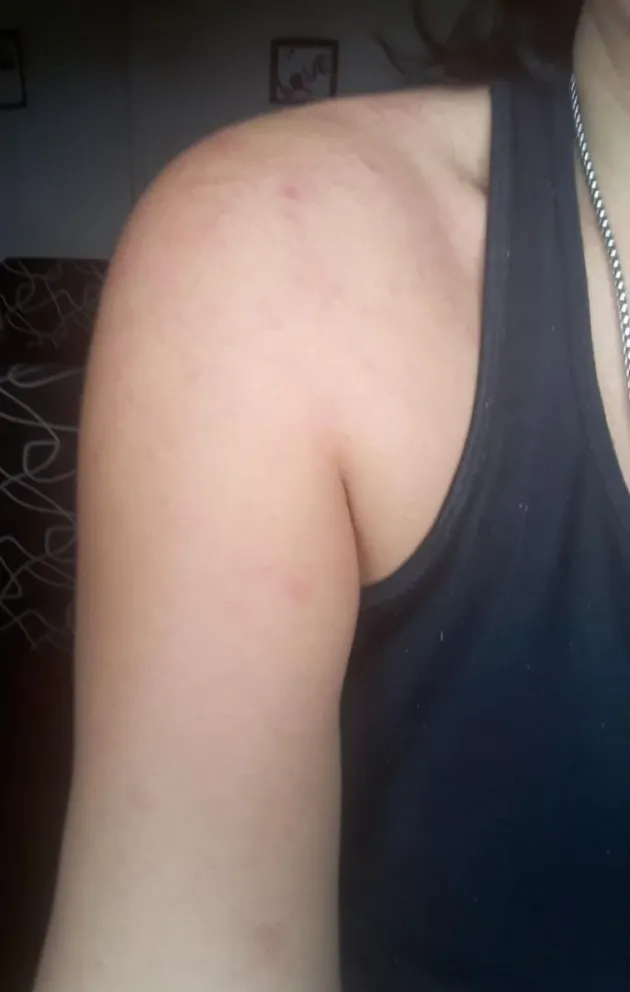 Una joven contrajo COVID-19 con síntomas de reacciones alérgicas en la piel
