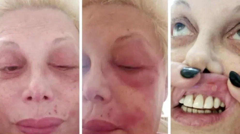 Carmen Barbieri tiene culebrilla: "Creo que toqué fondo, me duele la vida"