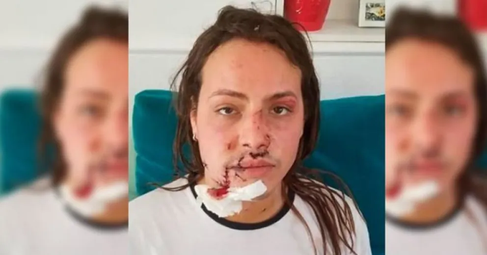 Joven trans fue acuchillada y se defendió del ataque con un vidrio