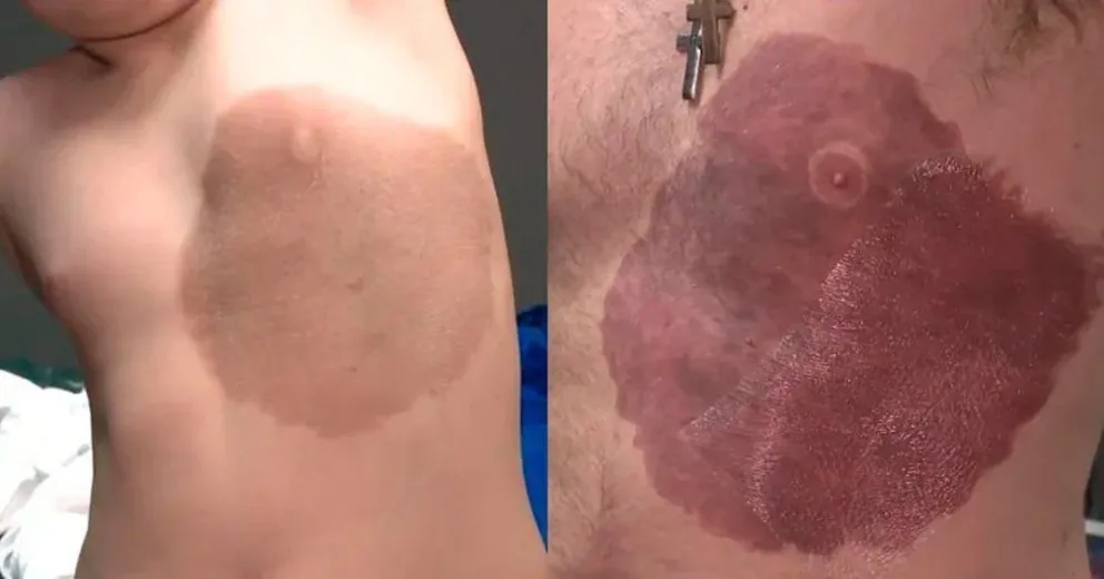 Canadá: se tatuó la mancha de nacimiento de su hijo para darle confianza