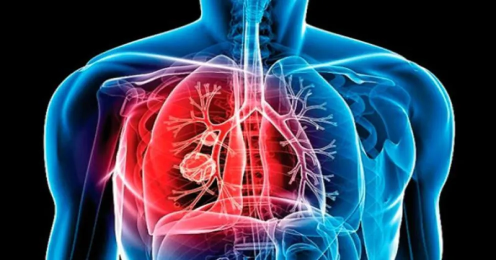 ¿Hay tuberculosis en Bariloche?