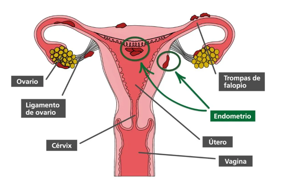 Endometriosis: no es necesario convivir con el dolor