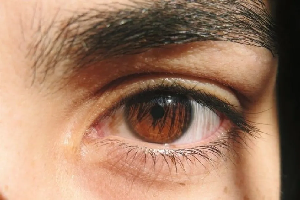 Se realizó el primer operativo doble de donación de tejido corneal en Río Negro