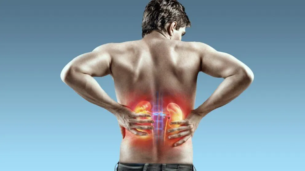 Cálculos renales: un problema que  afecta al 2 % de la población