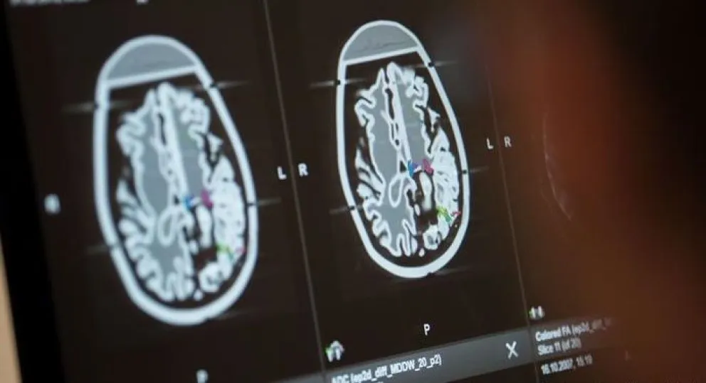 Estudio asegura que recuperados de Covid pueden sufrir pérdidas de materia gris